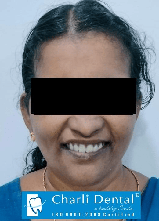 BPS Denture - After