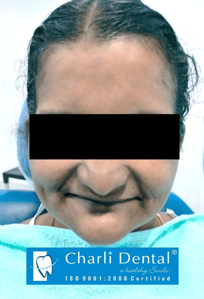 BPS Denture - Before